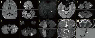 Acute Unilateral Audiovestibulopathy due to Embolic Labyrinthine Infarction